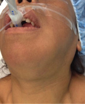 Deformidad facial por crecimiento óseo.
