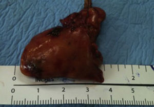 Adenoma paratiroideo inferior derecho.