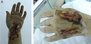 Fasciotomías realizadas en el miembro superior izquierdo. A)Cara volar. B)Cara dorsal. Fuente: autores.