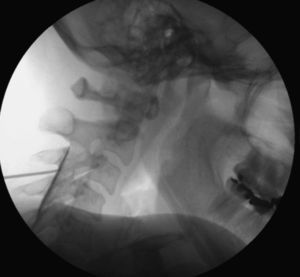 Epidural cervical en nivel C3 C4 confirmada con medio de contraste. Fuente: autores.