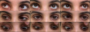Left conjugate gaze palsy: minimal abduction and mild delay on adduction.