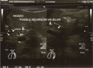 Imagen sonográfica sugestiva de A. lumbricoides.