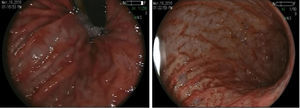 Mucosa de aspecto erosivo y puntilleo hemorrágico, con imagen en piel de serpiente tanto en cuerpo como antro gástrico, duodeno con zonas de epitelio aplanado, mucosa eritematosa y lesiones nodulares violáceas.