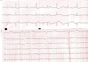 Electrocardiograma al ingreso mostrando bradicardia, bloqueo de rama derecha y ritmo de la unión, así como discreta elevación del segmento ST en derivaciones V1-V3.