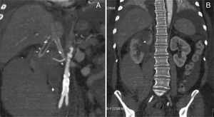 (A) and (B) Retroperitoneal hematoma with occlusion of the right graft branch and parcial infarction of the right kidney.