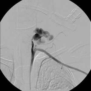 Angiografia de subtração digital, transecção da artéria vertebral (segmento V1) com extravasamento do produto de contraste.
