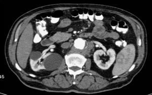 Pre-operatory CT scan showing an inflammatory mass surrounding the aneurysm and enclosing the left renal artery