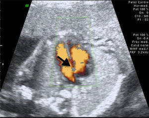 Axial cut at the heart level with the presence of membranous interventricular communication.