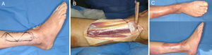 A. Defecto de cobertura por quemadura con exposición de tendones extensores. B. Cobertura con colgajo gracilis libre anastomosado a la arteria y la vena dorsal del pie e injerto de piel parcial. Aspecto postoperatorio inmediato. C. Resultado a los 5 meses.