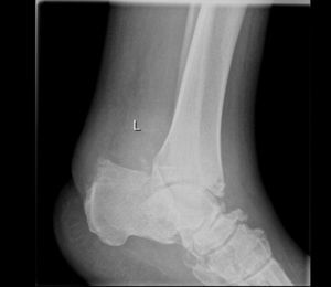 Paciente con artropatía de Charcot.