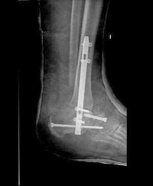 Triple artrodesis en el mismo paciente de la figura 1.