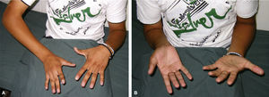 Octavo año postoperatorio. (A) Pronación activa. (B) Supinación activa