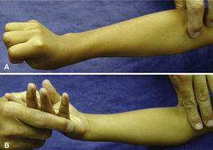 (A) Paciente con hemiparesia espástica. Antebrazo en pronación marcada, muñeca en extensión y pulgar en flexo y aducto. (B) Maniobra preoperatoria para comprobar la supinación pasiva completa del antebrazo.