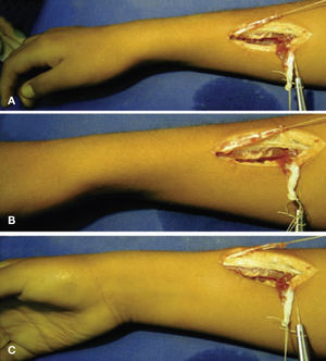 (A) Incisión en tercio medio del antebrazo se obtiene un hemitendón del braquiorradial y se desinserta el pronador redondo del radio. (B-C) Al traccionar del hemitendón del braquiorradial se consigue la supinación de la muñeca.