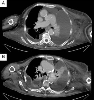 Tomografia axial computerizada de tórax sin contraste intravenoso. Derrame pleural derecho de escasa cuantía y derrame pleural izquierdo importante encapsulado, con realce de pleura (lo cual traduce engrosamiento pleural). El líquido es de baja densidad radiológica compatible con linfa. Apreciamos edema de tejido celular subcutáneo en mayor cuantía en lado izquierdo. A) Corte a nivel de arteria pulmonar derecha. B) Corte cercano a carina donde también apreciamos ateromatosis y dilatación aneurismática de la aorta ascendente.