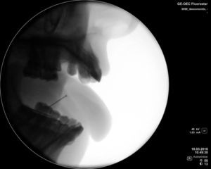 Visión radioscópica de las agujas de coser. Imagen intraoperatoria.