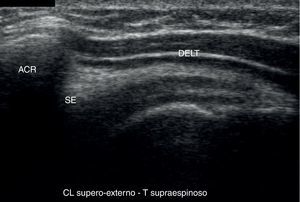 4mL were infiltrated in the subdeltoid bursa.
