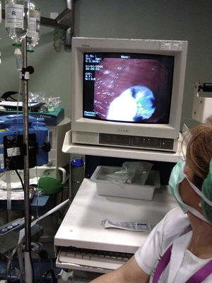Placement of the intragastric balloon.