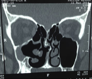 Single coronal section of CT scan showing asymmetry of both maxillary sinuses, with collapsed right maxillary sinus, hypoglobus and anomalous implantation of the middle concha.