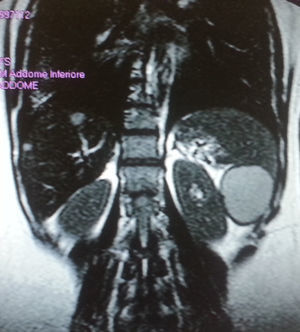 Magnetic resonance imaging of the abdomen (coronal reconstruction) revealed a septated cyst occupying the lower pole of the spleen. The lesion was 6m×4cm in diameter and appeared hyperintense on T2-weighted images, displacing the remaining splenic parenchyma (termed bird-beak sign).